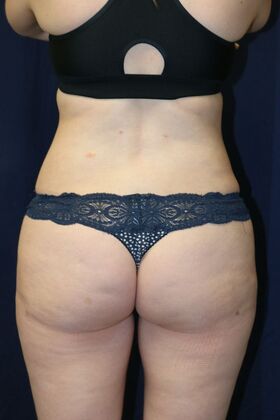 Liposuction & Safe Lipo Case 53 - After