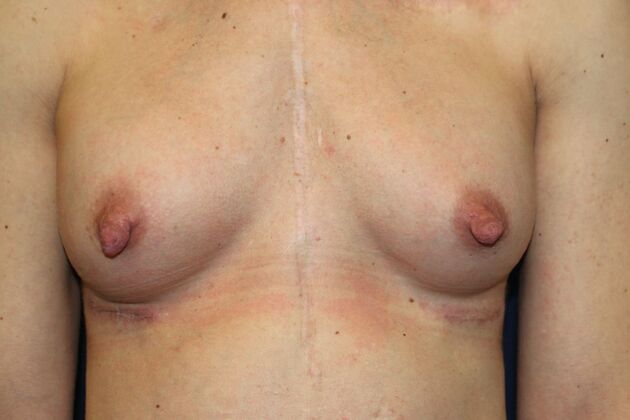 NIPPLE REDUCTION: Case 1 - Before