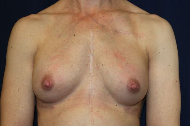 NIPPLE REDUCTION: Case 1 - After