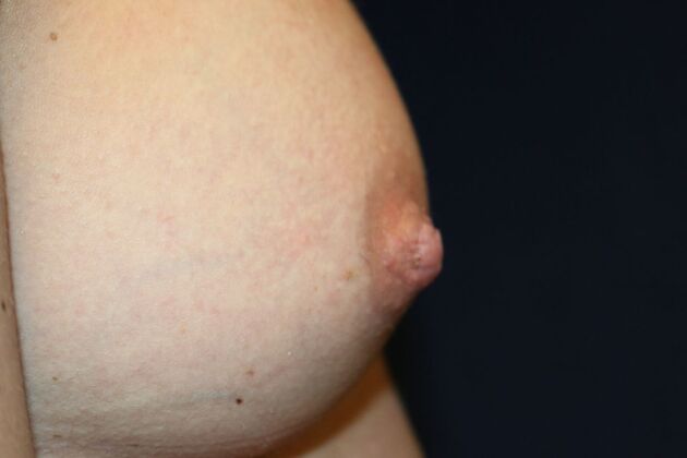 NIPPLE REDUCTION: Case 1 - After