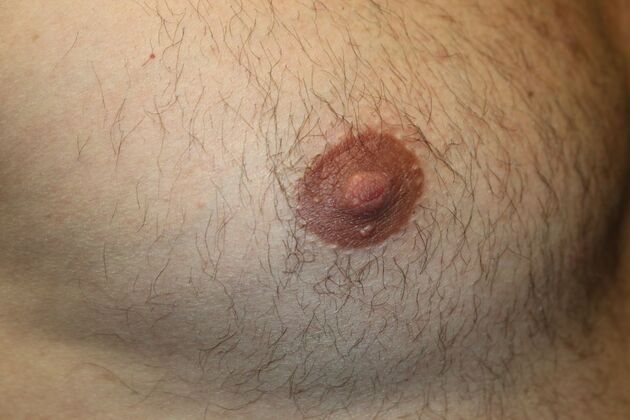 NIPPLE REDUCTION: Case 4 - After