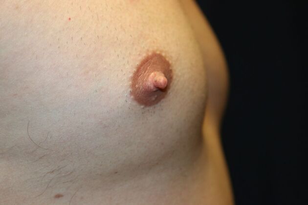 NIPPLE REDUCTION: Case 4 - Before