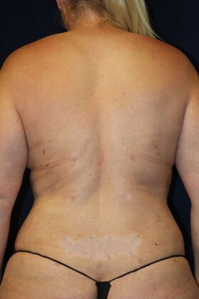 Liposuction & Safe Lipo Case 54 - After