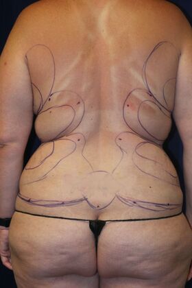 Liposuction & Safe Lipo Case 54 - Before