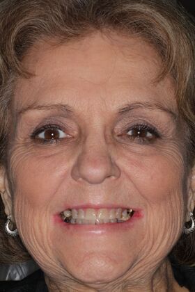 Full Mouth Reconstruction Case 10 - Before