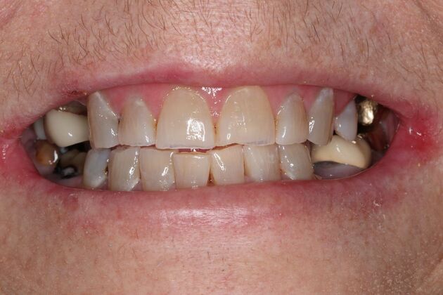 Full Mouth Reconstruction: Case 10 - Before