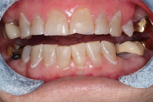 Full Mouth Reconstruction: Case 10 - Before