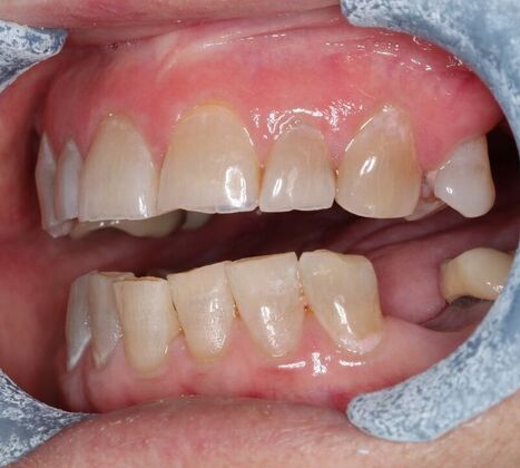 Full Mouth Reconstruction: Case 10 - Before