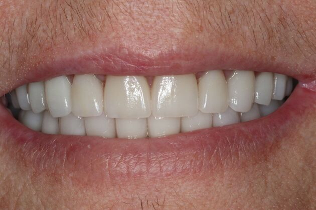 Full Mouth Reconstruction: Case 10 - After