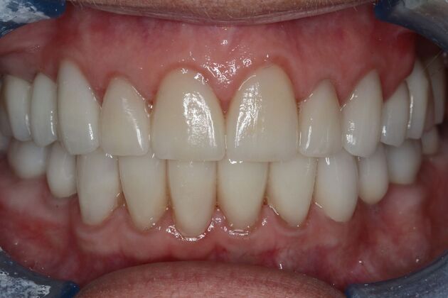Full Mouth Reconstruction: Case 10 - After