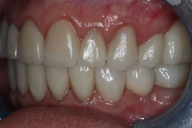 Full Mouth Reconstruction: Case 10 - After