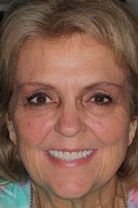 Full Mouth Reconstruction Case 10 - After