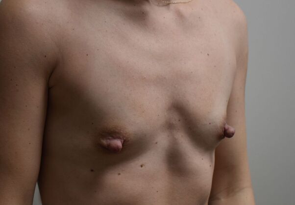 Breast Augmentation: Case 725 - Before