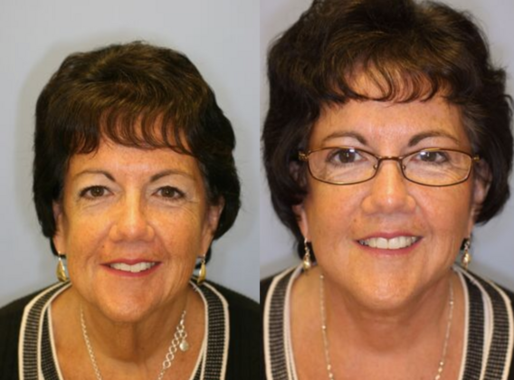 Facial Rejuvenation Cases