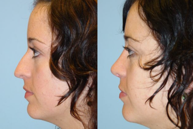 Rhinoplasty Cases