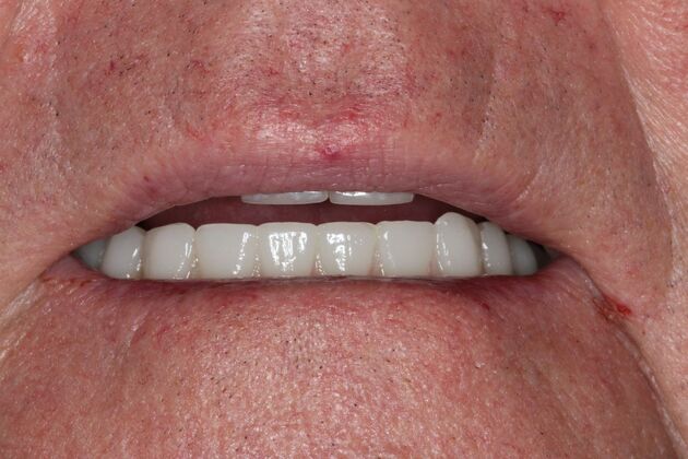 Teeth In A Day: Case 29 - After