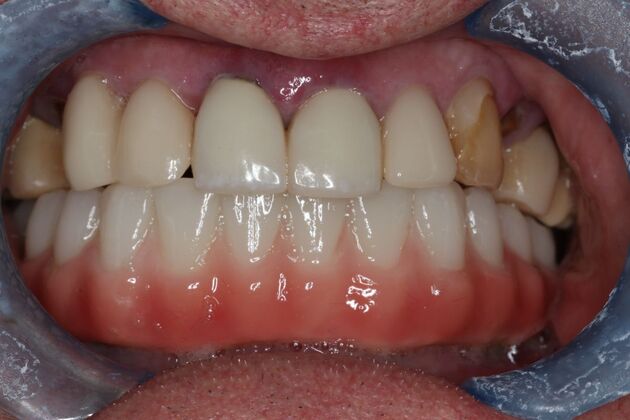 Teeth In A Day Case 29 - After