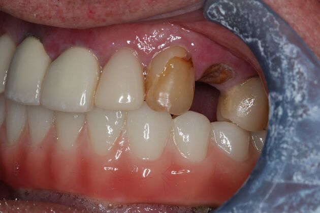 Teeth In A Day: Case 29 - After