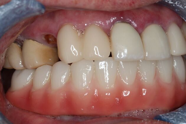 Teeth In A Day: Case 29 - After