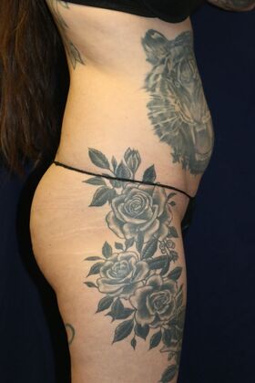 Brazilian Butt Lift : Case 9 - Before