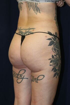 Brazilian Butt Lift : Case 9 - After