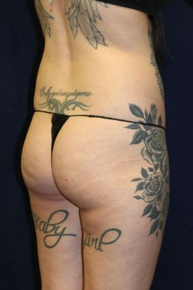 Brazilian Butt Lift : Case 9 - Before