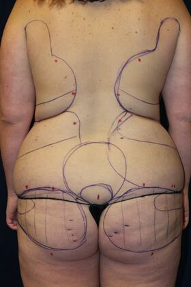 Brazilian Butt Lift : Case 18 - Before