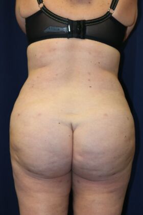 Brazilian Butt Lift : Case 18 - After