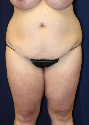 Brazilian Butt Lift : Case 18 - Before