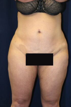Brazilian Butt Lift : Case 18 - After