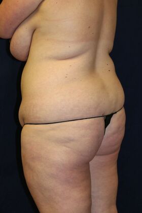 Brazilian Butt Lift : Case 18 - Before