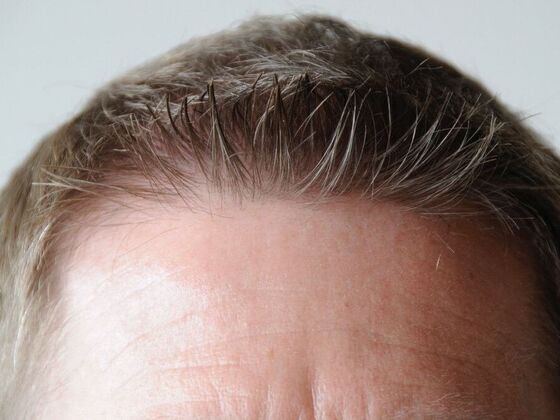 FUT Hair Restoration Case 22 - After