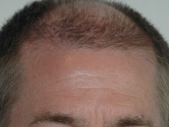 FUT Hair Restoration Case 22 - Before