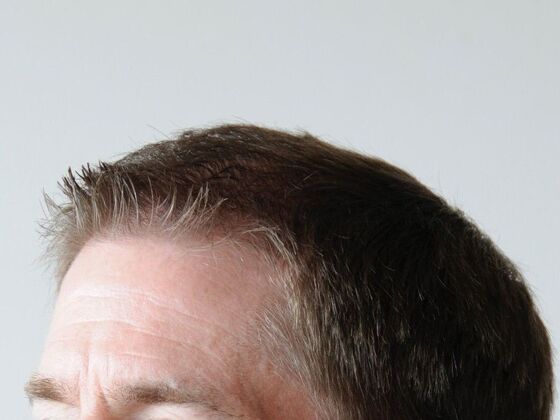 FUT Hair Restoration: Case 22 - After