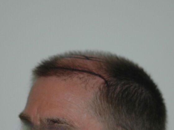 FUT Hair Restoration: Case 22 - Before