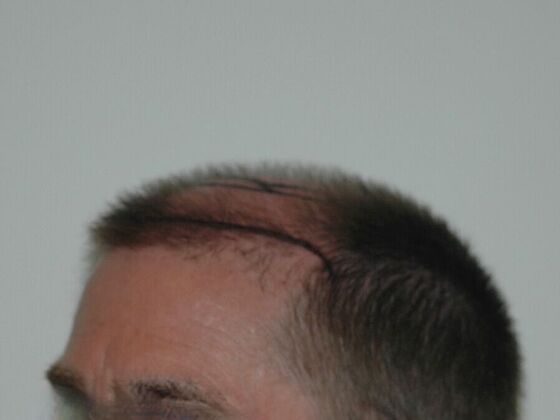 FUT Hair Restoration: Case 22 - Before
