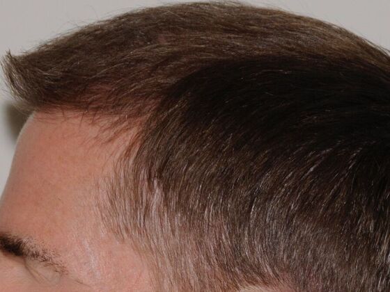 FUT Hair Restoration: Case 22 - After