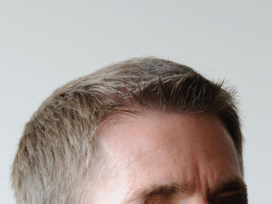 FUT Hair Restoration: Case 22 - After