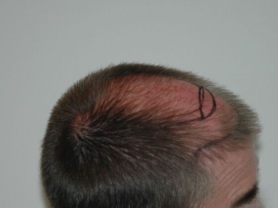 FUT Hair Restoration: Case 22 - Before