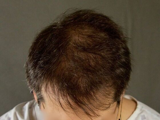 FUE Hair Restoration: Case 11 - Before