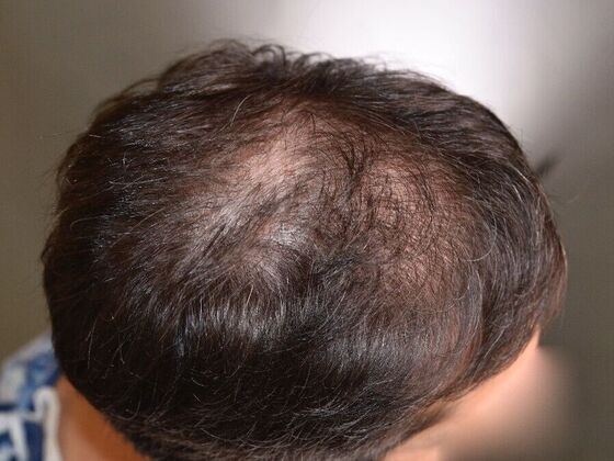 FUE Hair Restoration: Case 11 - Before