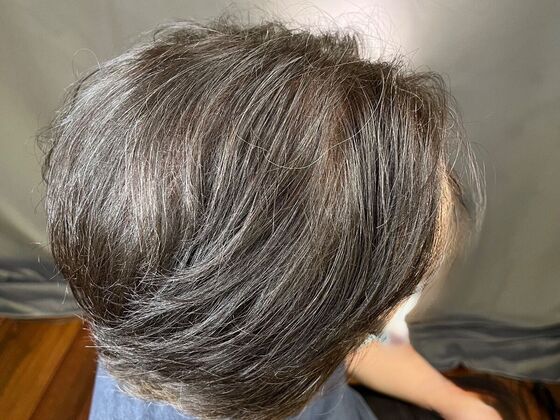 FUE Hair Restoration: Case 11 - After