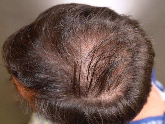 FUE Hair Restoration: Case 11 - Before