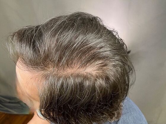 FUE Hair Restoration: Case 11 - After