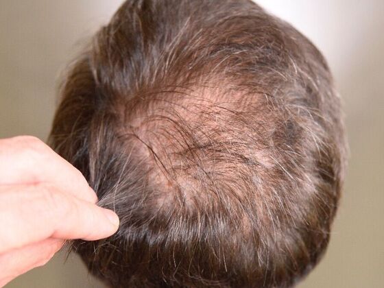 FUE Hair Restoration: Case 11 - Before