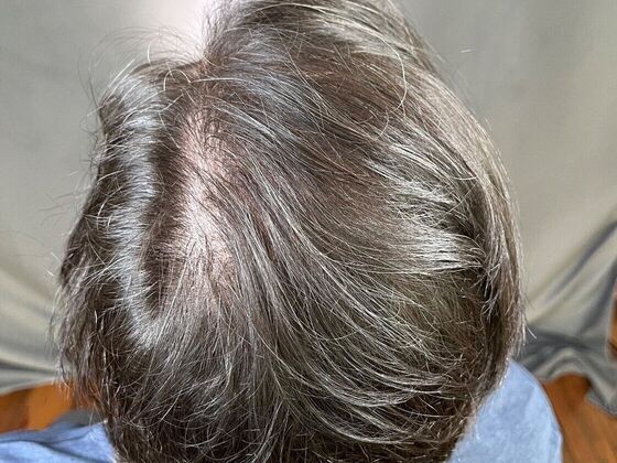 FUE Hair Restoration: Case 11 - After