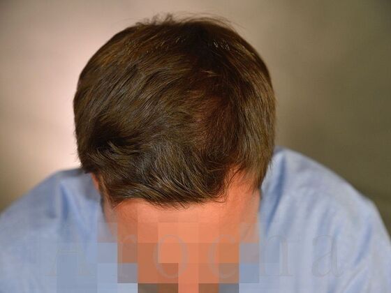 FUE Hair Restoration: Case 10 - After