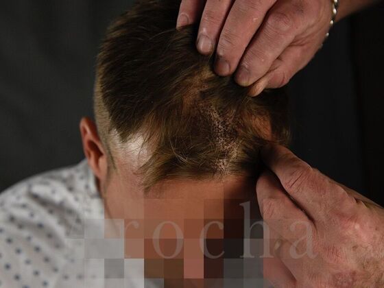 FUE Hair Restoration: Case 10 - Before