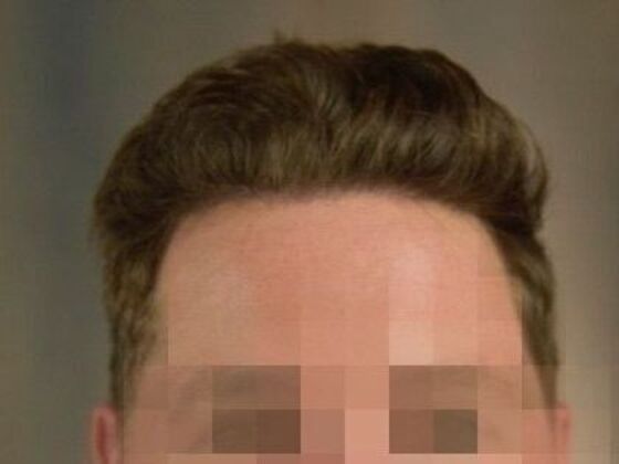 FUE Hair Restoration: Case 19 - After