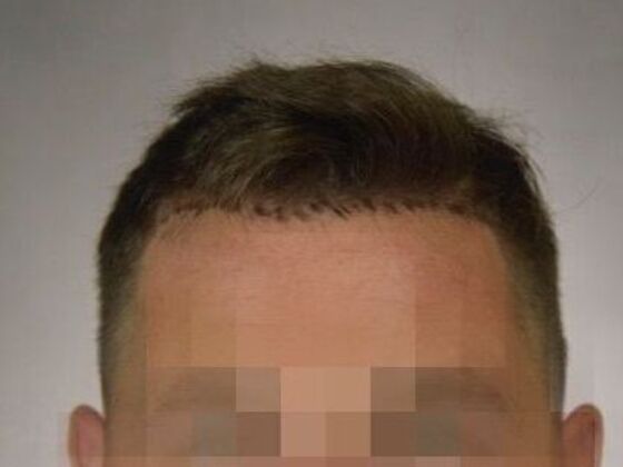 FUE Hair Restoration: Case 19 - Before